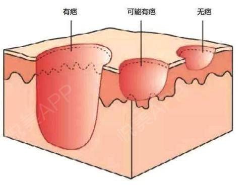 點痣會留疤嗎？