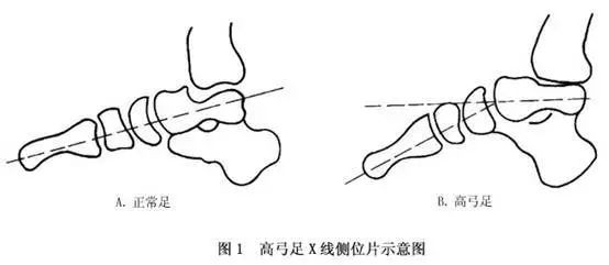 腳形圖樣_腳形_腳形狀的命運圖解